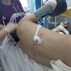 Мопедист, из груди которого достали метровый штырь, после операции смог дышать самостоятельно
