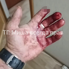 Прокуратура проверяет сообщение о владивостокце, которому собака откусила палец (ФОТО 18+)