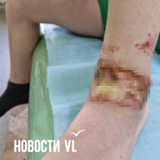 В Приморье 7-летний мальчик в детском саду прыгнул в золу и сжёг кожу на ногах